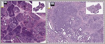 約翰霍普金斯大學：抗寄生蟲藥物減緩小鼠胰腺癌