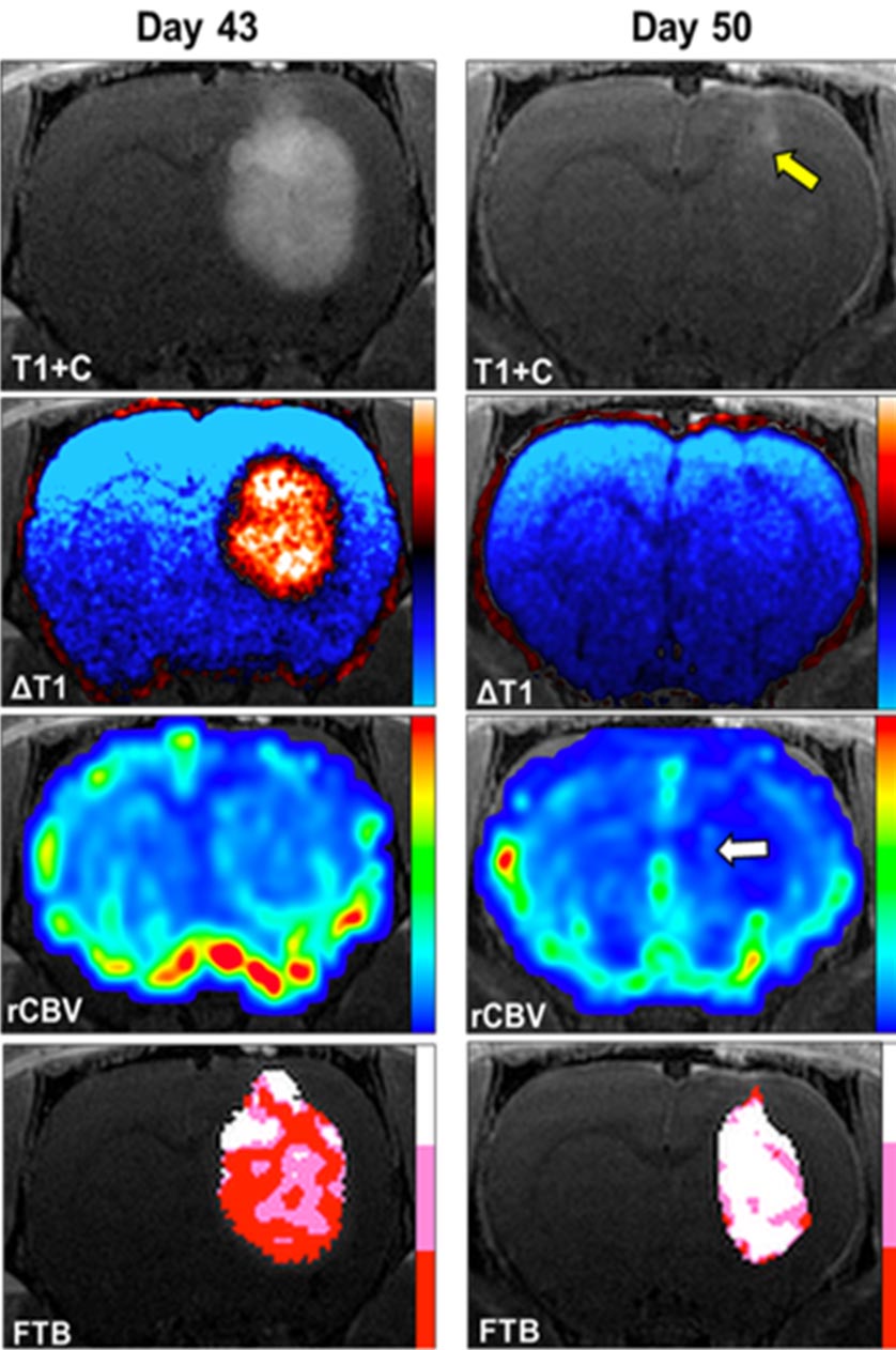 高級 MRI 腦癌 腫瘤